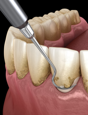 periodoncia